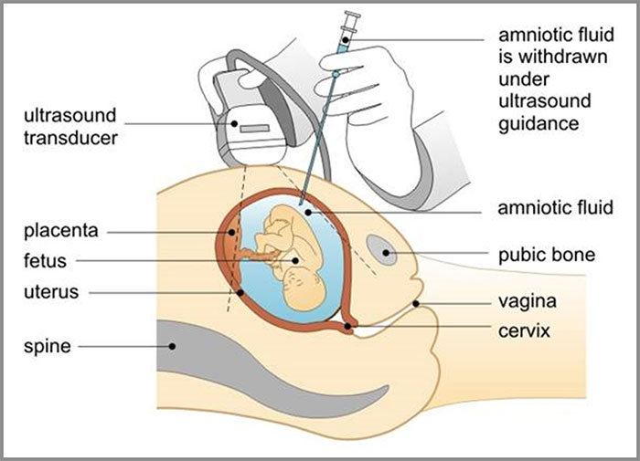 Fetal Procedures, Amniocentesis | Prof.Dr. İnanç Mendilcioğlu ...